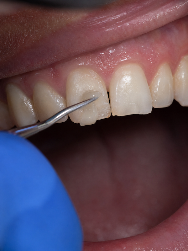 Diseño de sonrisa con carillas de resina, procedimiento en Clínica Cielō