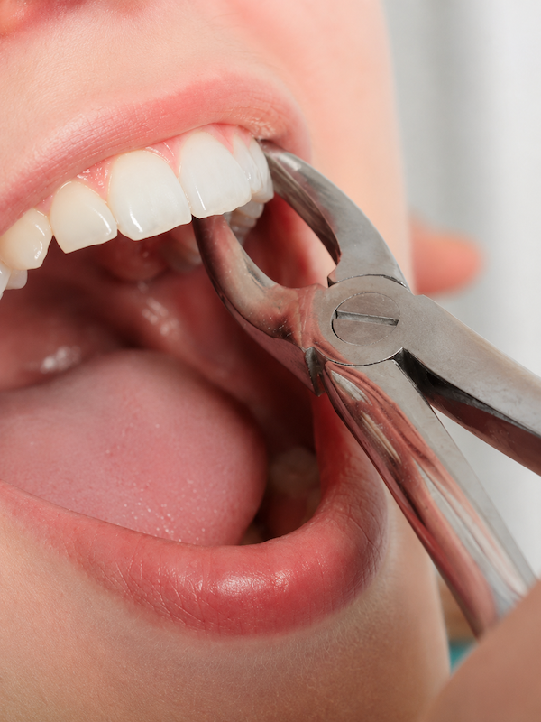 Extracciones dentales Clínica Cielō